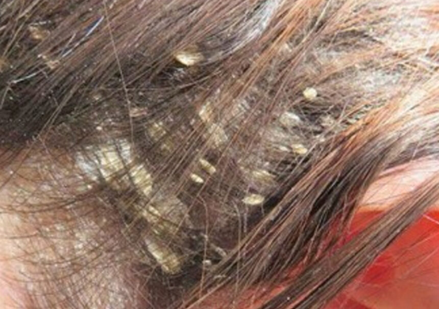 Lo que encontraron en su cabello sorprendió a todos los doctores
