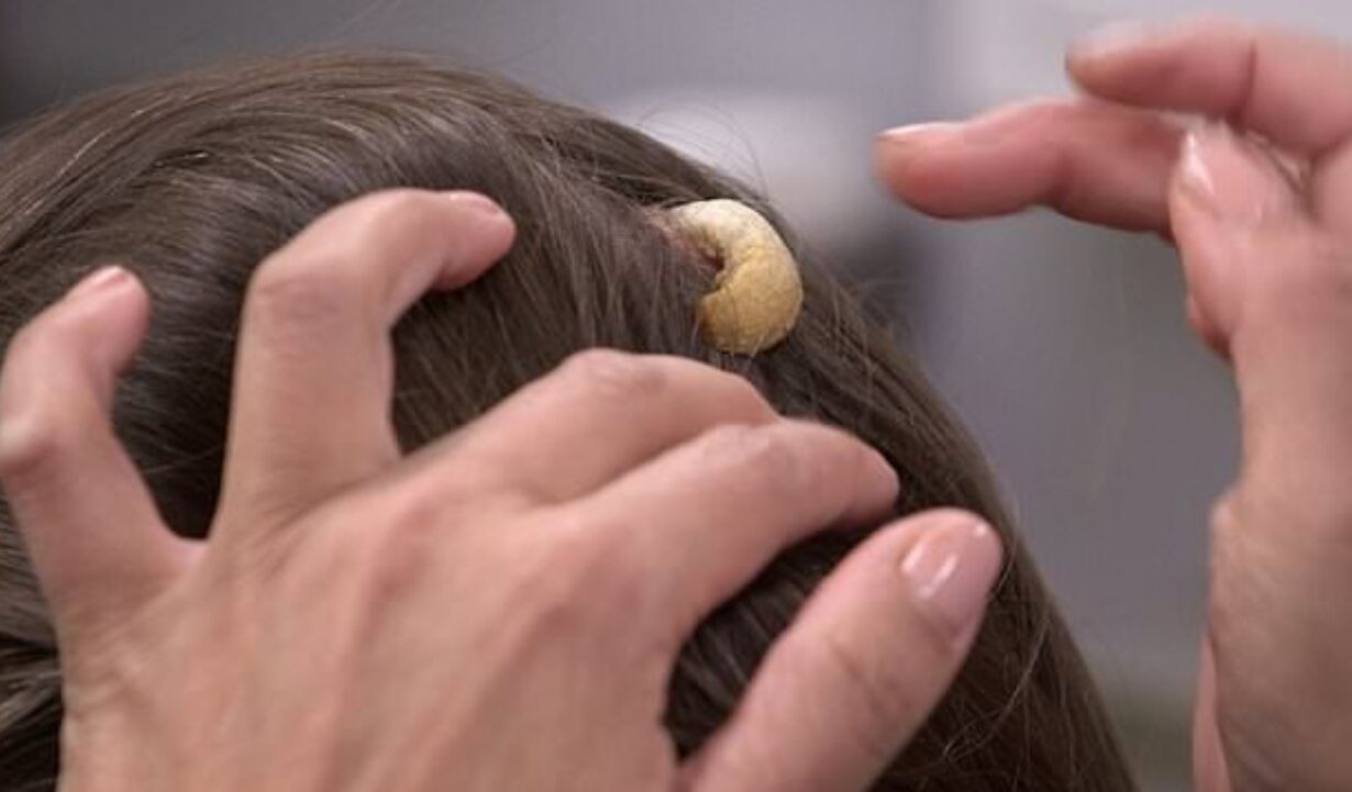 A una mujer de 43 años le está creciendo un cuerno en la cabeza. Es enorme