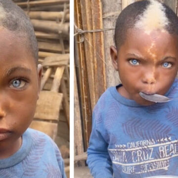 Niño africano sorprende a todos por sus increíbles ojos azules y su marca de nacimiento en forma de rayo